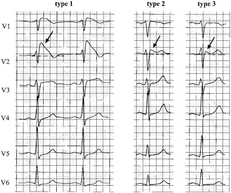 BrS异常心电图定义和分型